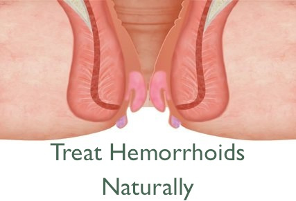 minor-external-hemorrhoids