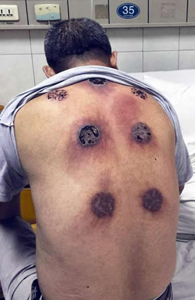 Cupping burns