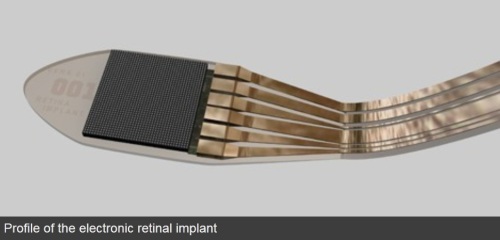 Electronic implant 1_profile